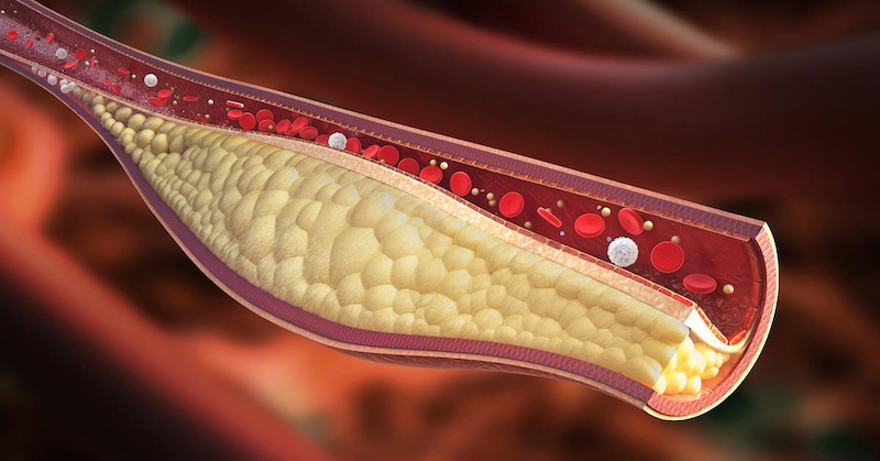 Priemysel statínových liekov zarába obscénne zisky na lži o cholesterole a zjednodušovaní srdcových chorôb