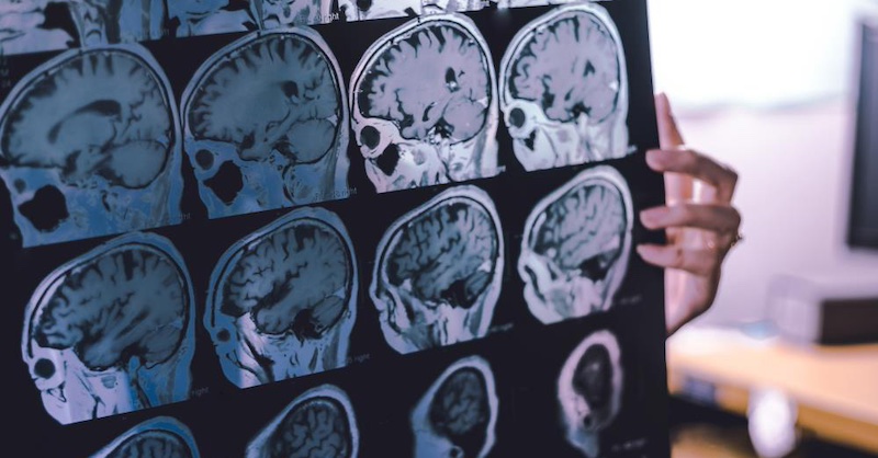 3 menej známe bylinky môžu zvrátiť demenciu, Alzheimerovu a Parkinsonovu chorobu